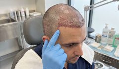 Folikülit ve Sebum Yönetimi